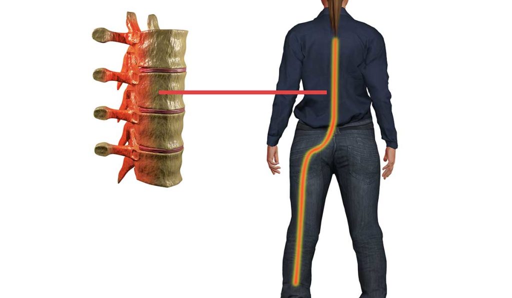 Sciatica Treatment and Conservative Solutions