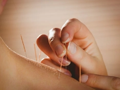Acupuncture Treatment London